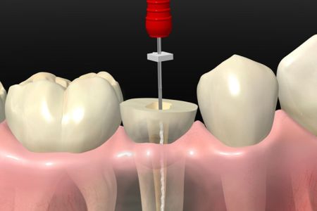 Endodoncia