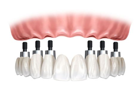 PRÓTESIS DENTALES